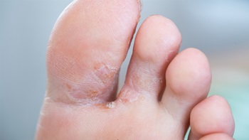 mycose-infections-fongiques-pieds